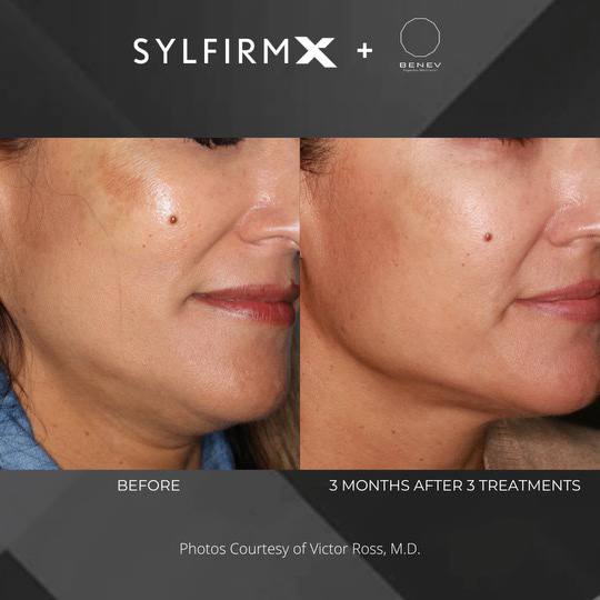 Sylfirm X patient before and after photos