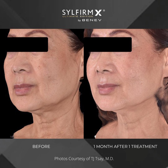 Sylfirm X patient before and after photos