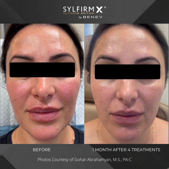 Sylfirm X patient before and after photos