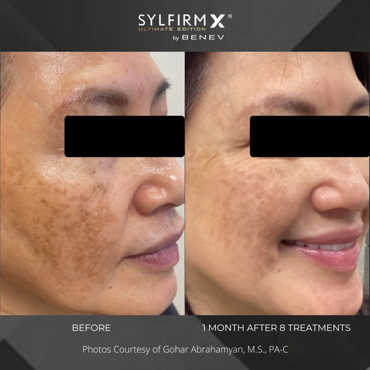 Sylfirm X patient before and after photos