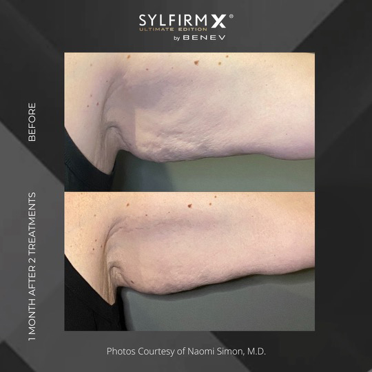 Sylfirm X patient before and after photos