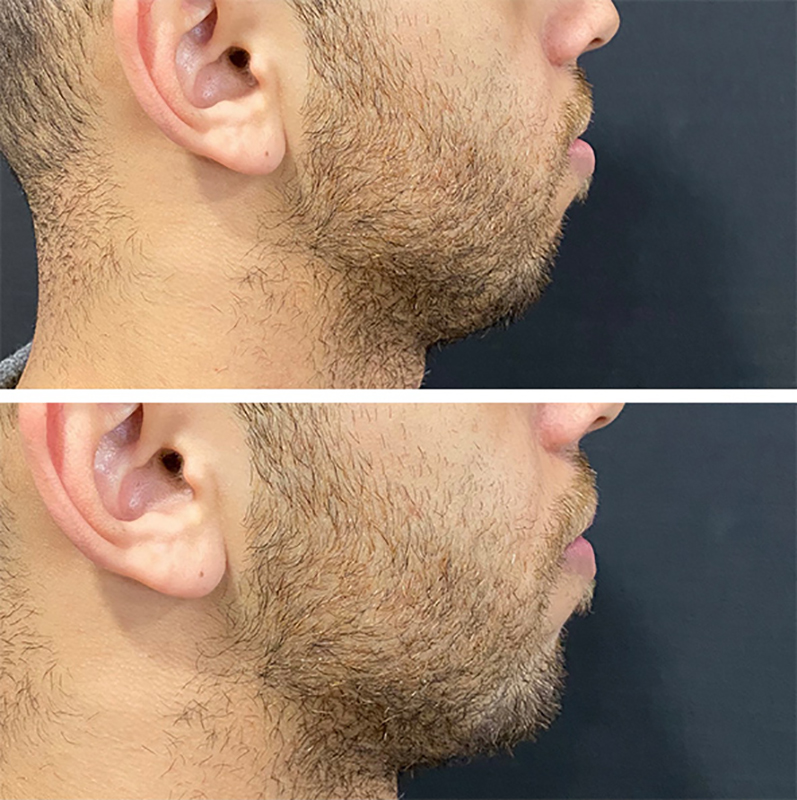 Chin Augmentation Before & After Photo