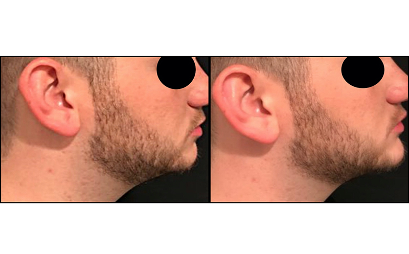 Chin Augmentation Before & After Photo