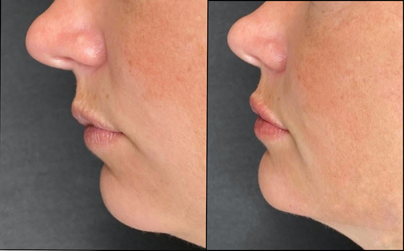 Chin Augmentation Before & After Photo