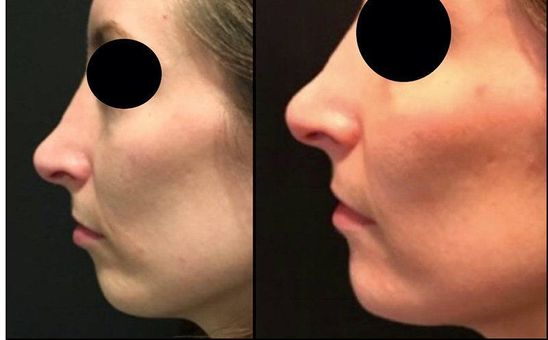 Chin Augmentation Before & After Photo