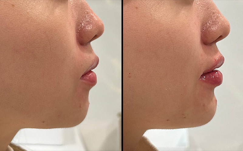 Chin Augmentation Before & After Photo