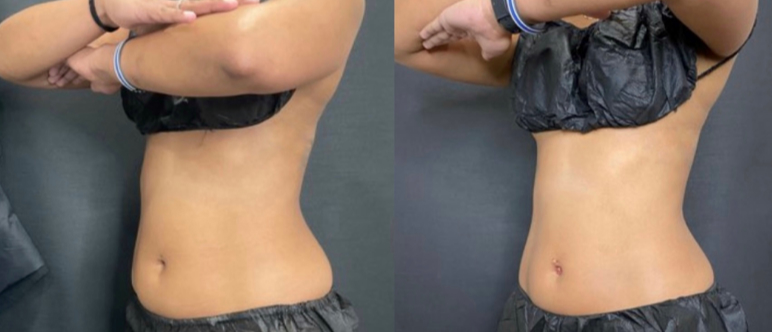 CoolSculpting Elite Before & After Photo