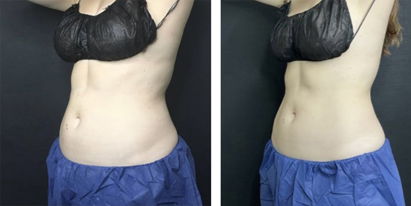 CoolSculpting Before & After Photo