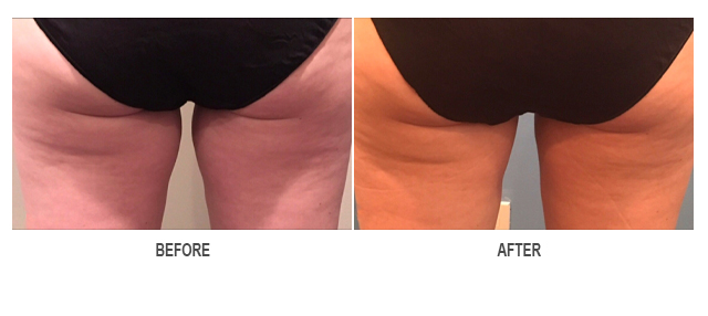 CoolSculpting Before & After Photo