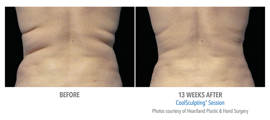 CoolSculpting Before & After Photo