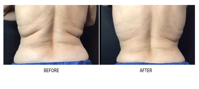 CoolSculpting Before & After Photo