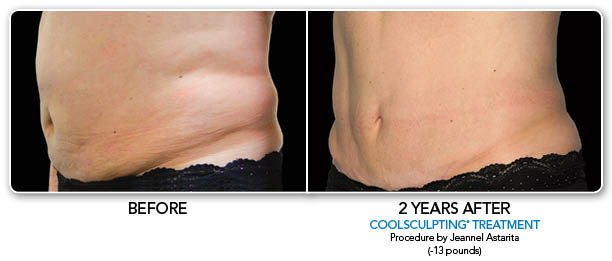 CoolSculpting Before & After Photo