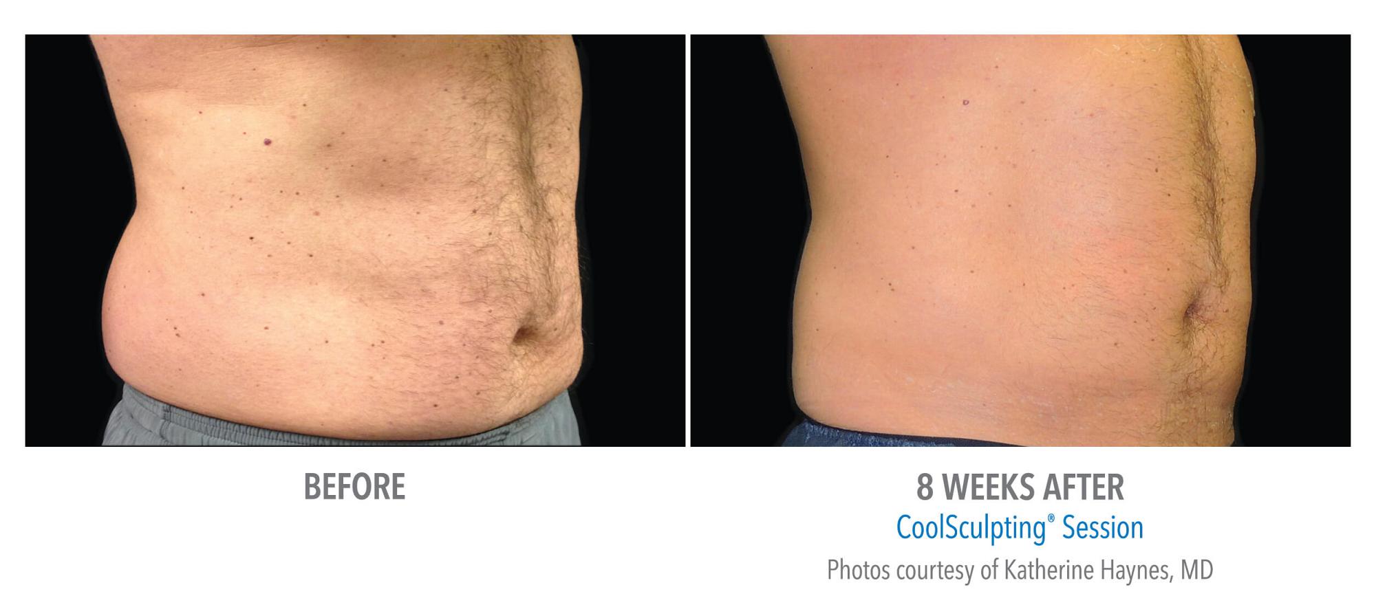 CoolSculpting Before & After Photo