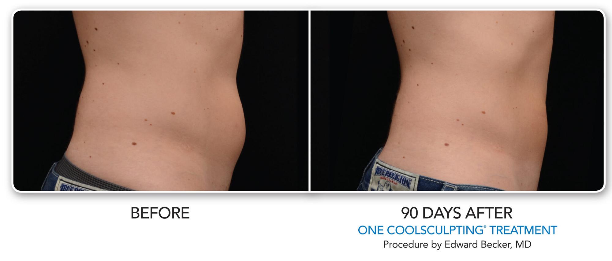 CoolSculpting Before & After Photo