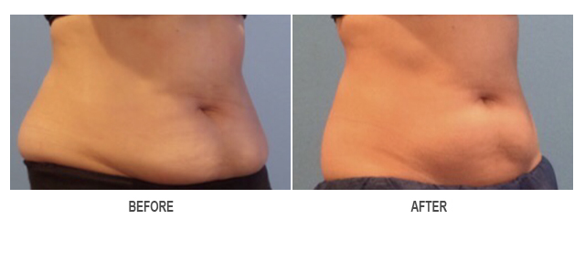 CoolSculpting Before & After Photo