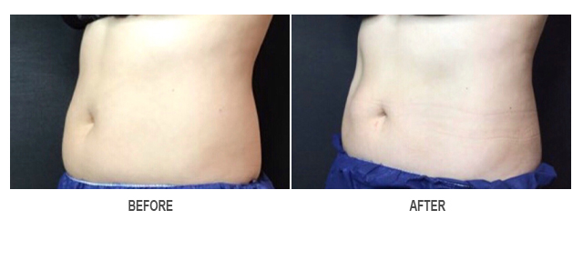 CoolSculpting Before & After Photo