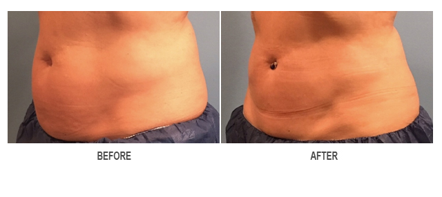 CoolSculpting Before & After Photo