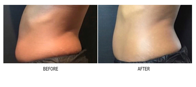 CoolSculpting Before & After Photo