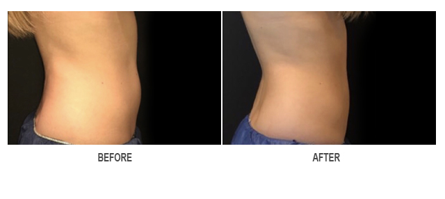 CoolSculpting Before & After Photo