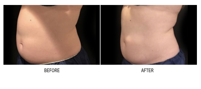 CoolSculpting Before & After Photo