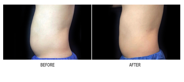 CoolSculpting Before & After Photo