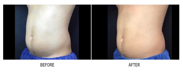 CoolSculpting Before & After Photo