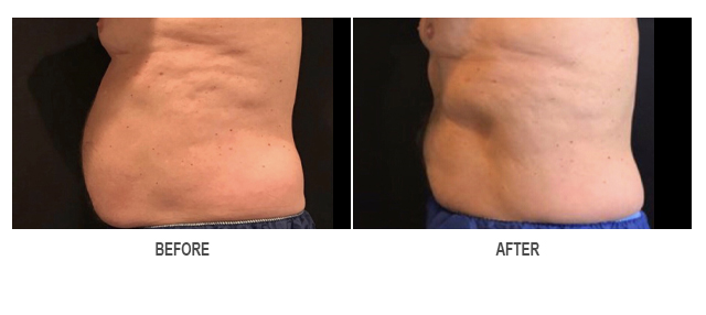 CoolSculpting Before & After Photo