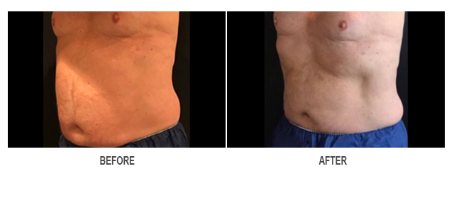 CoolSculpting Before & After Photo