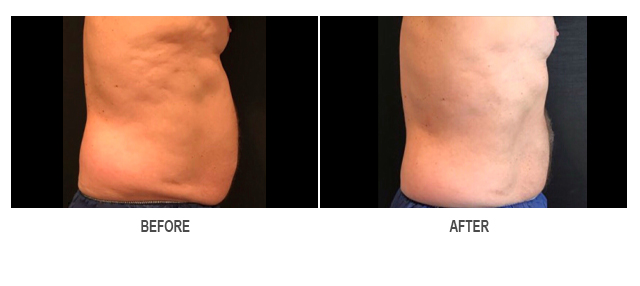 CoolSculpting Before & After Photo