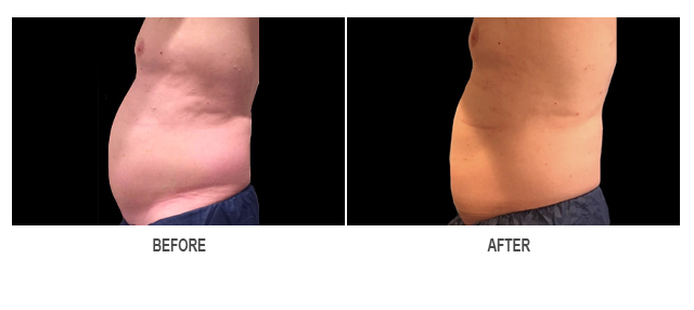 CoolSculpting Before & After Photo