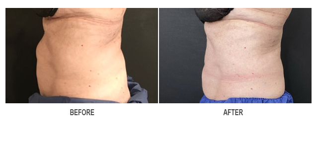 CoolSculpting Before & After Photo