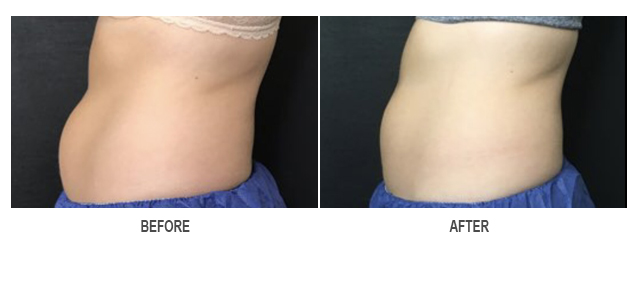 CoolSculpting Before & After Photo