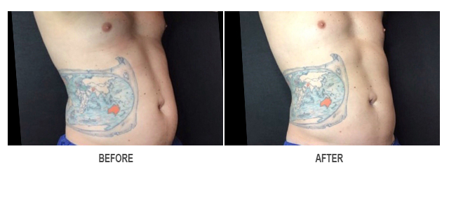 CoolSculpting Before & After Photo