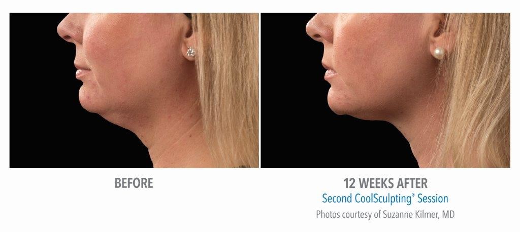 CoolSculpting Before & After Photo