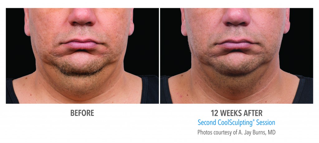 CoolSculpting Before & After Photo