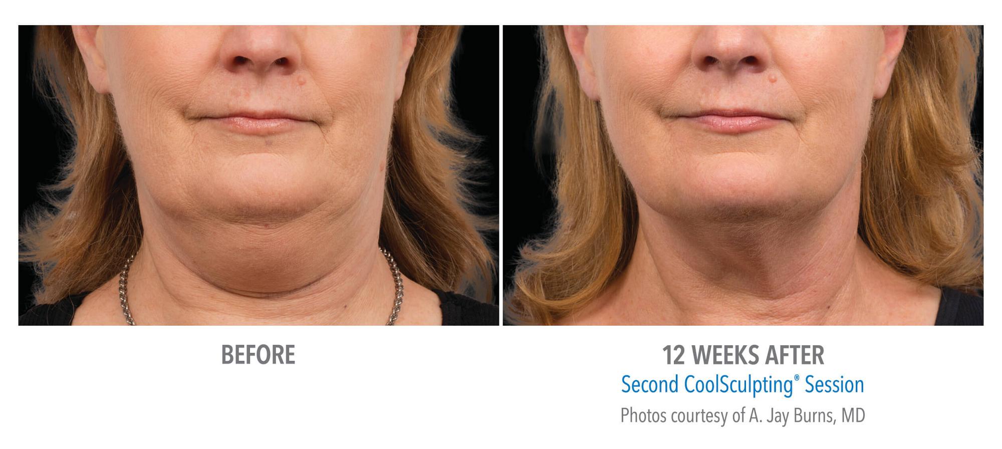 CoolSculpting Before & After Photo