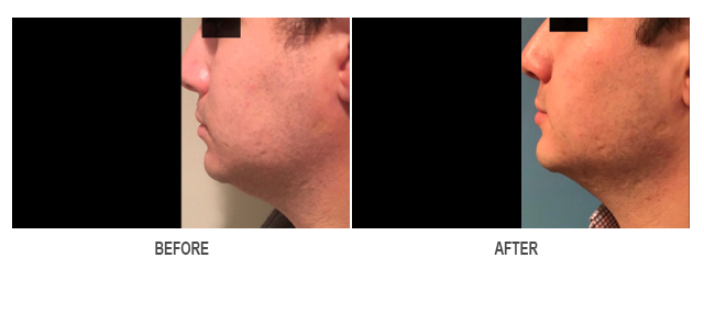 CoolSculpting Before & After Photo