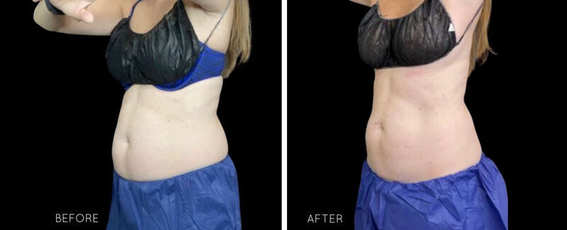 CoolSculpting Before & After Photo