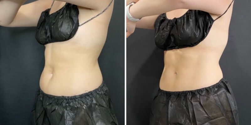 CoolSculpting Before & After Photo