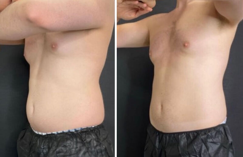 CoolSculpting Before & After Photo