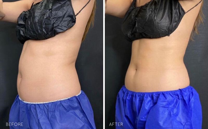 CoolSculpting Before & After Photo