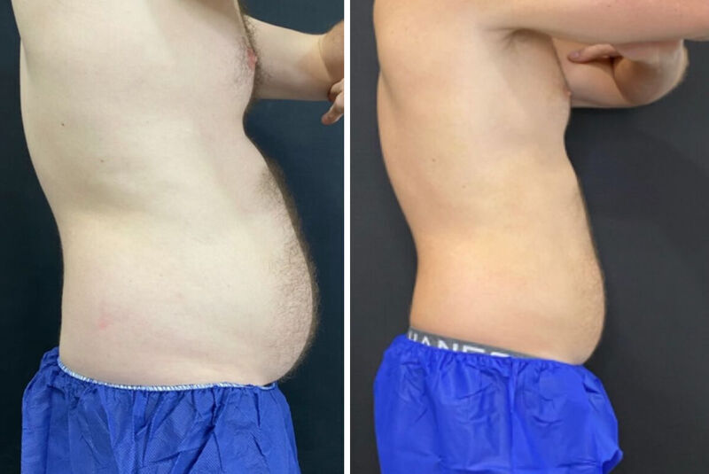 CoolSculpting Before & After Photo