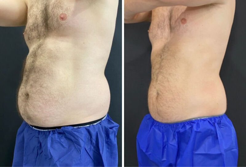 CoolSculpting Before & After Photo