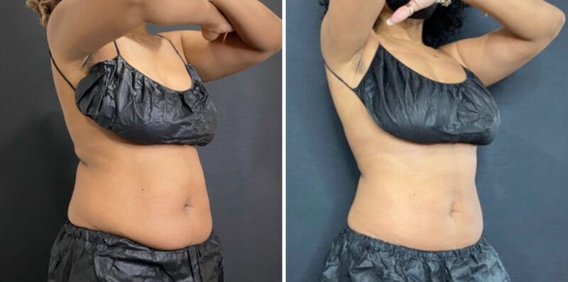 CoolSculpting Before & After Photo