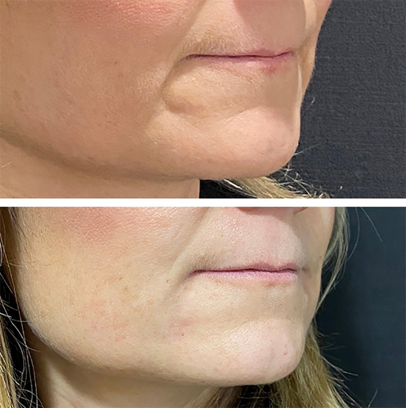 Facial Fillers Before & After Photo