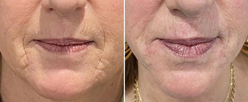 Facial Fillers Before & After Photo