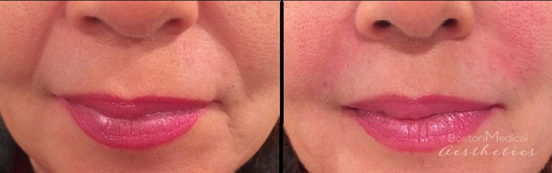 Facial Fillers Before & After Photo