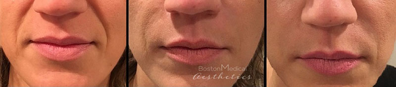 Facial Fillers Before & After Photo