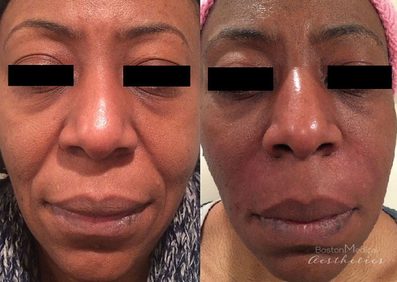 Facial Fillers Before & After Photo