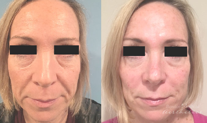 Facial Fillers Before & After Photo